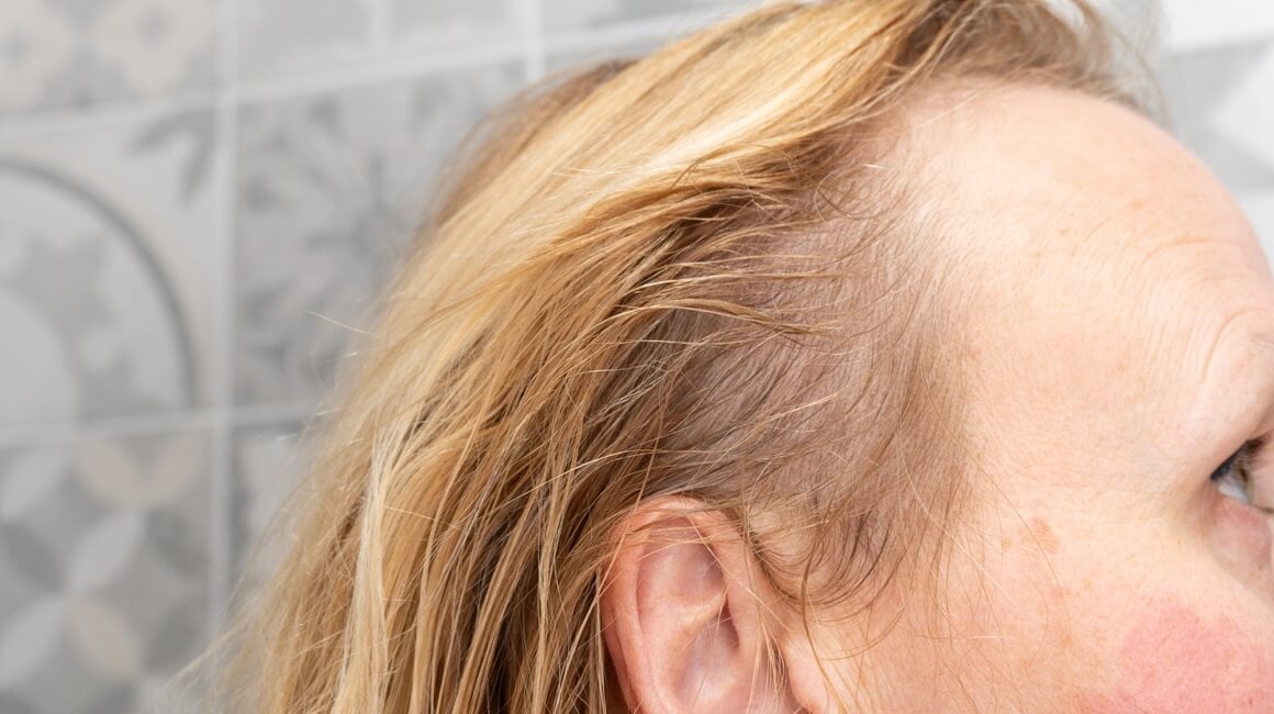 Gubitak kose može biti iznenađujuća i neugodno vidljiva nuspojava nekih lijekova za artritis