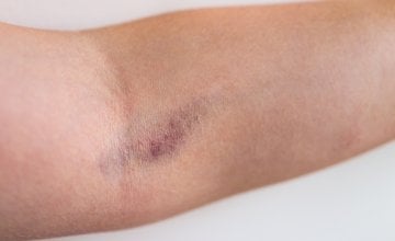 Kako prepoznati tromb u ruci