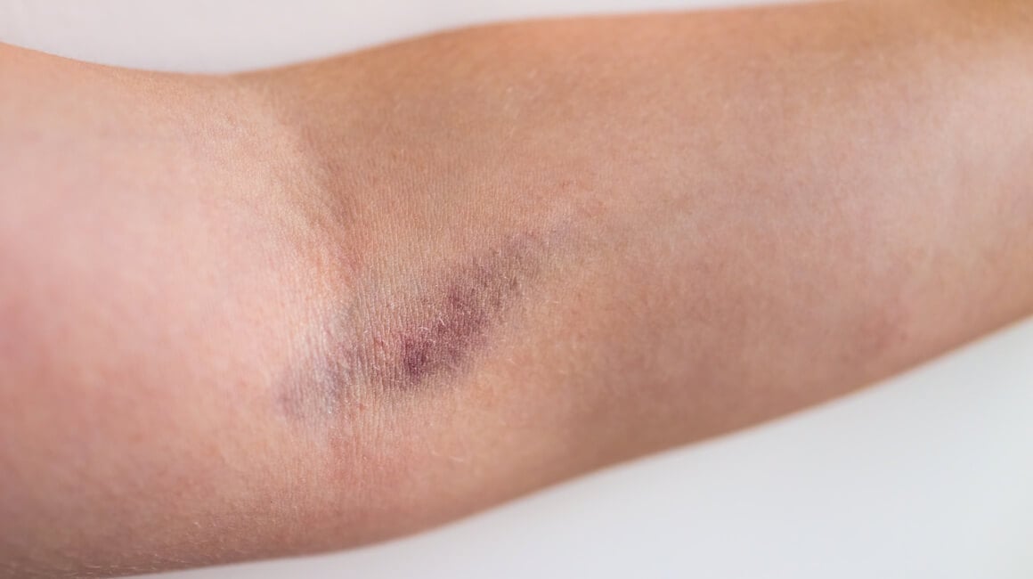 Kako prepoznati tromb u ruci