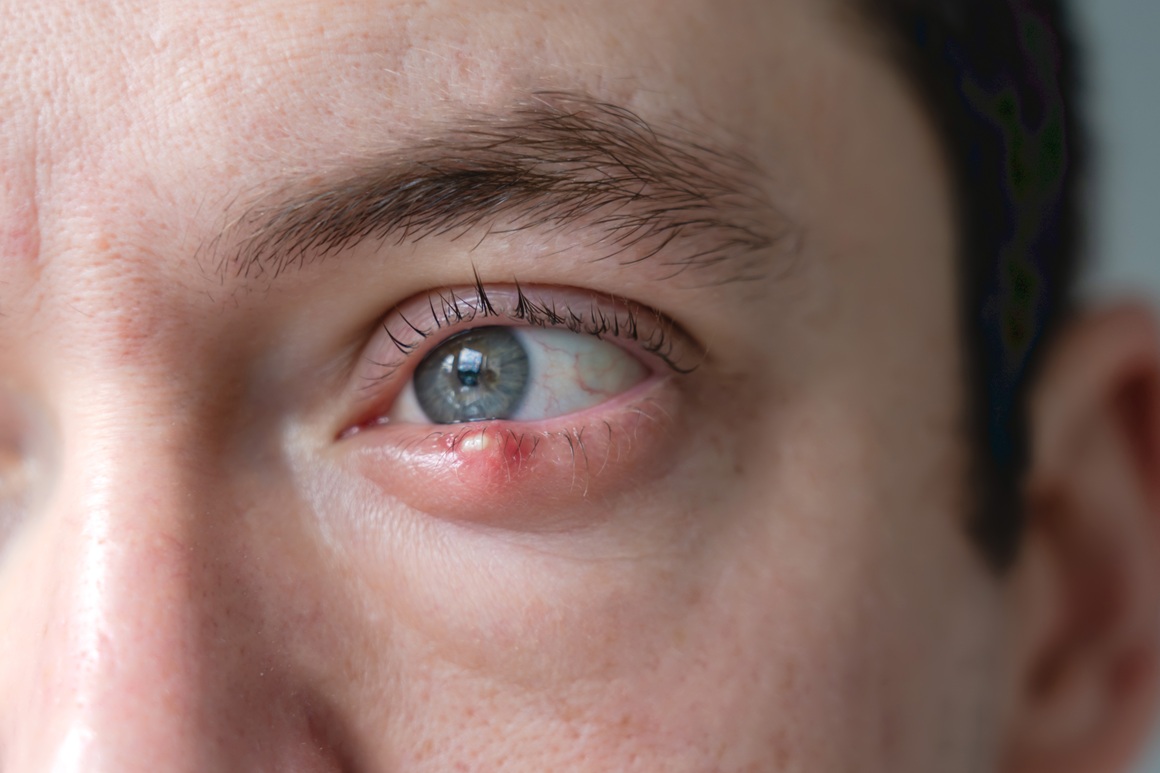 Kako se liječi snježno sljepilo