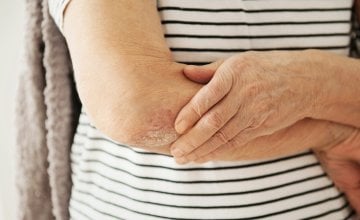 Kod psorijaze koža se obnavlja mnogo brže nego što bi trebala, što dovodi do nakupljanja srebrnih ili sivih ljuskica na upaljenim područjima