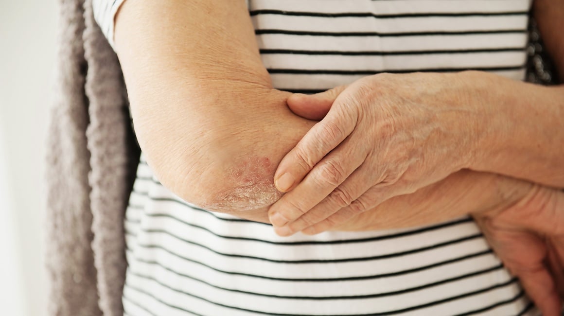 Kod psorijaze koža se obnavlja mnogo brže nego što bi trebala, što dovodi do nakupljanja srebrnih ili sivih ljuskica na upaljenim područjima