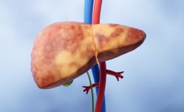 Mislite da imate samo masnu jetru Evo zašto biste trebali provjeriti i srce