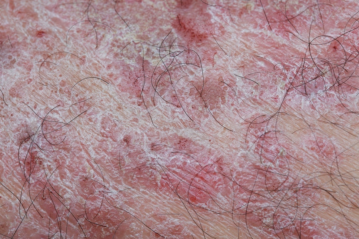 Nakupljene ljuskice mogu zatezati kožu, uzrokovati bol i ograničiti pokretljivost