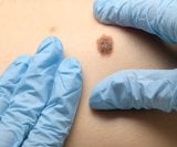 Ova navika gotovo utrostručuje rizik od najsmrtonosnijeg raka kože!