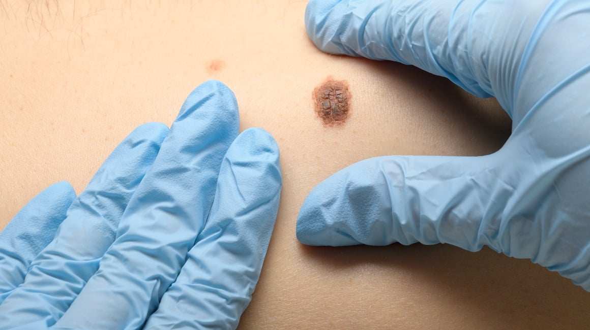 Ova navika gotovo utrostručuje rizik od najsmrtonosnijeg raka kože!