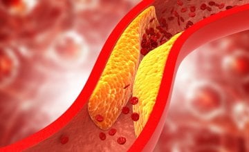 Plak u arterijama Što ga uzrokuje i kako ga smanjiti