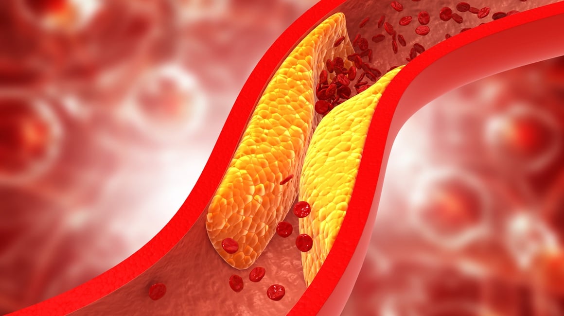 Plak u arterijama Što ga uzrokuje i kako ga smanjiti