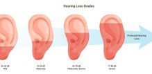 Stupnjevi oštećenja sluha