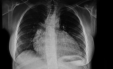 Uvećano srce (kardiomegalija)