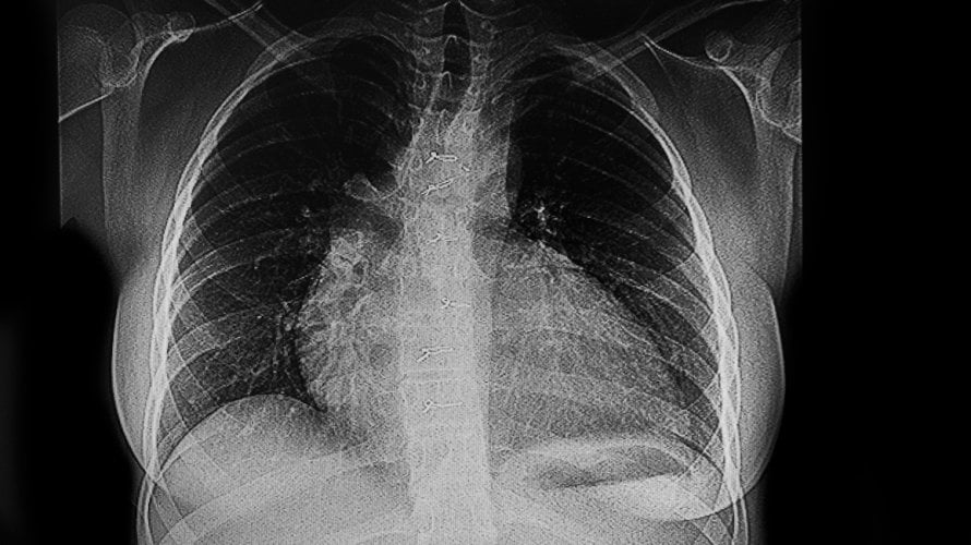 Uvećano srce (kardiomegalija)