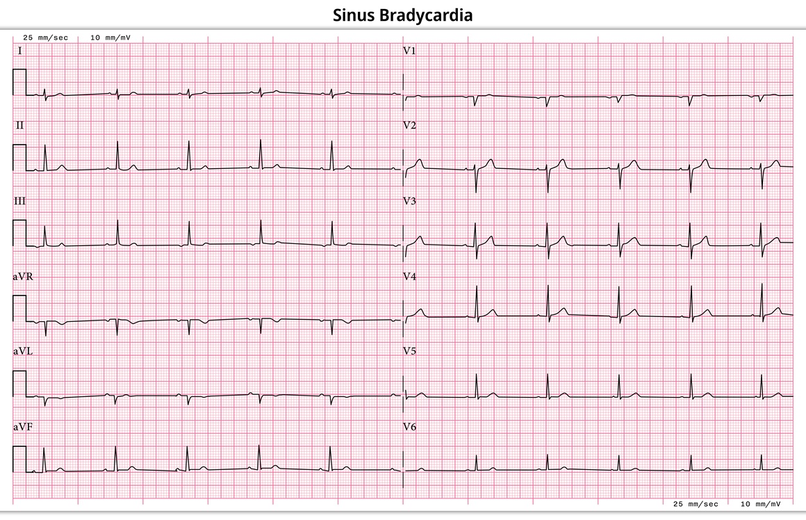 Vrste srčanog bloka i simptomi