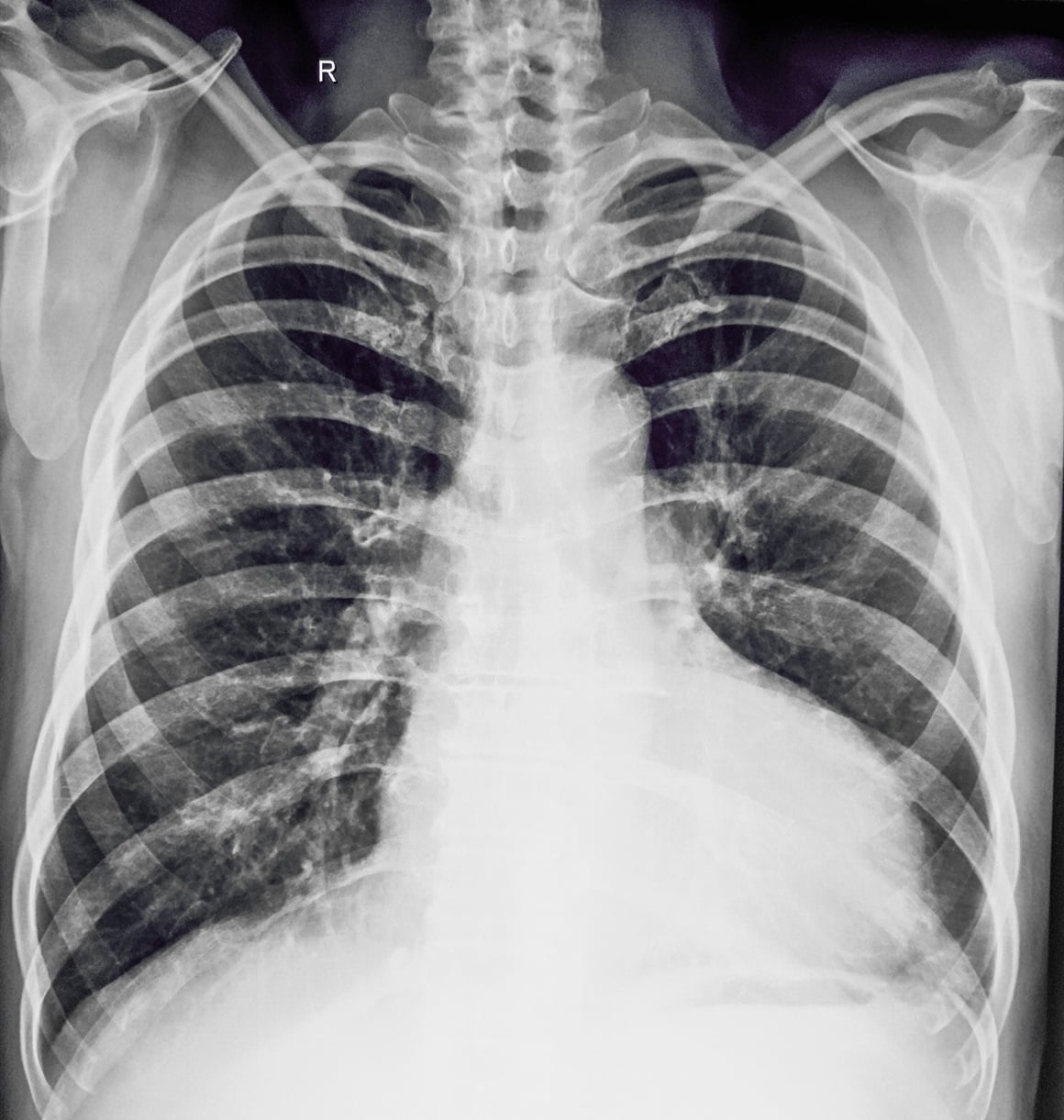 uvećano srce (kardiomegalija)