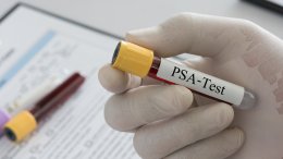 Ako nakon operacije ili zračenja raka prostate primijetite porast PSA vrijednosti, niste jedini - s tim se problemom suoči i do trećine muškaraca