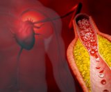 Ateroskleroza i arterioskleroza