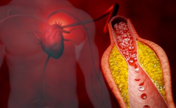 Ateroskleroza i arterioskleroza