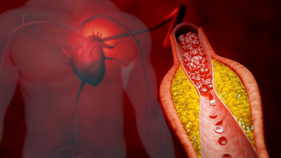 Ateroskleroza i arterioskleroza