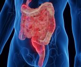 Crohnova bolest spada u skupinu upalnih bolesti crijeva (IBD) i pogađa milijune ljudi diljem svijeta