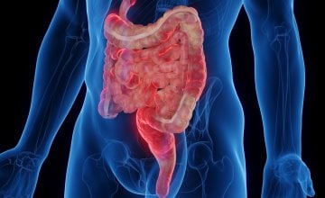 Crohnova bolest spada u skupinu upalnih bolesti crijeva (IBD) i pogađa milijune ljudi diljem svijeta