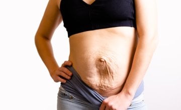 Dijastaza trbušnih mišića