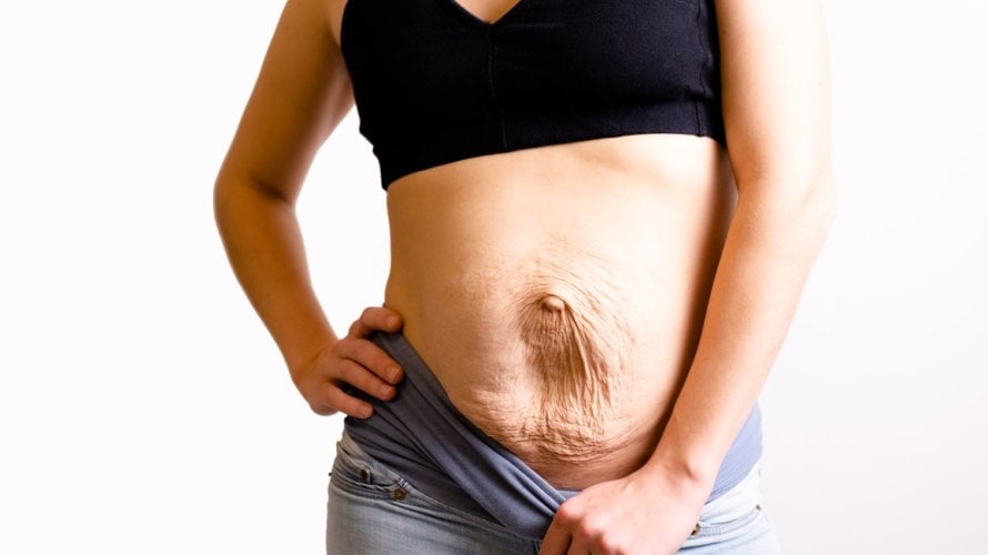 Dijastaza trbušnih mišića