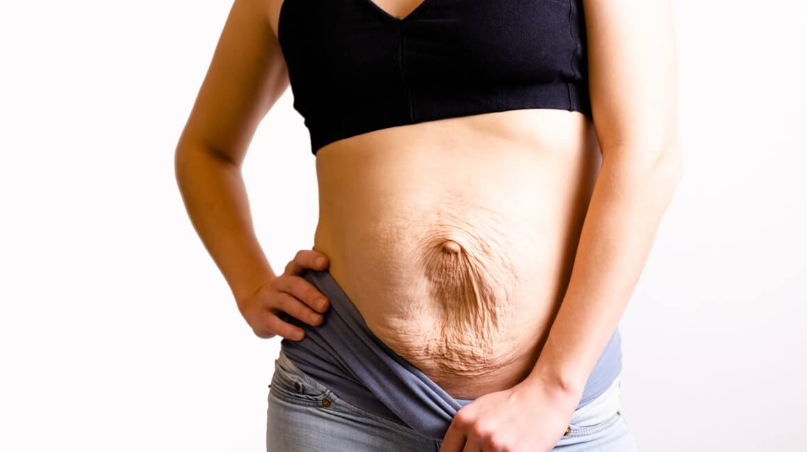 Dijastaza trbušnih mišića