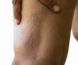 Duboka venska tromboza (DVT) ozbiljno je zdravstveno stanje