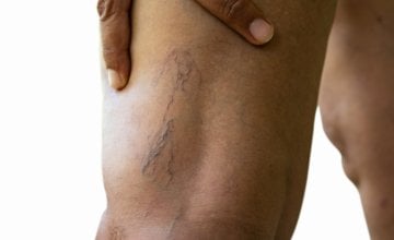 Duboka venska tromboza (DVT) ozbiljno je zdravstveno stanje