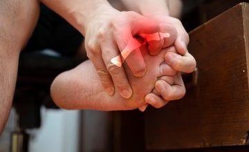 Giht je izuzetno bolna vrsta upalnog artritisa