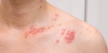 Herpes zoster nije rijedak
