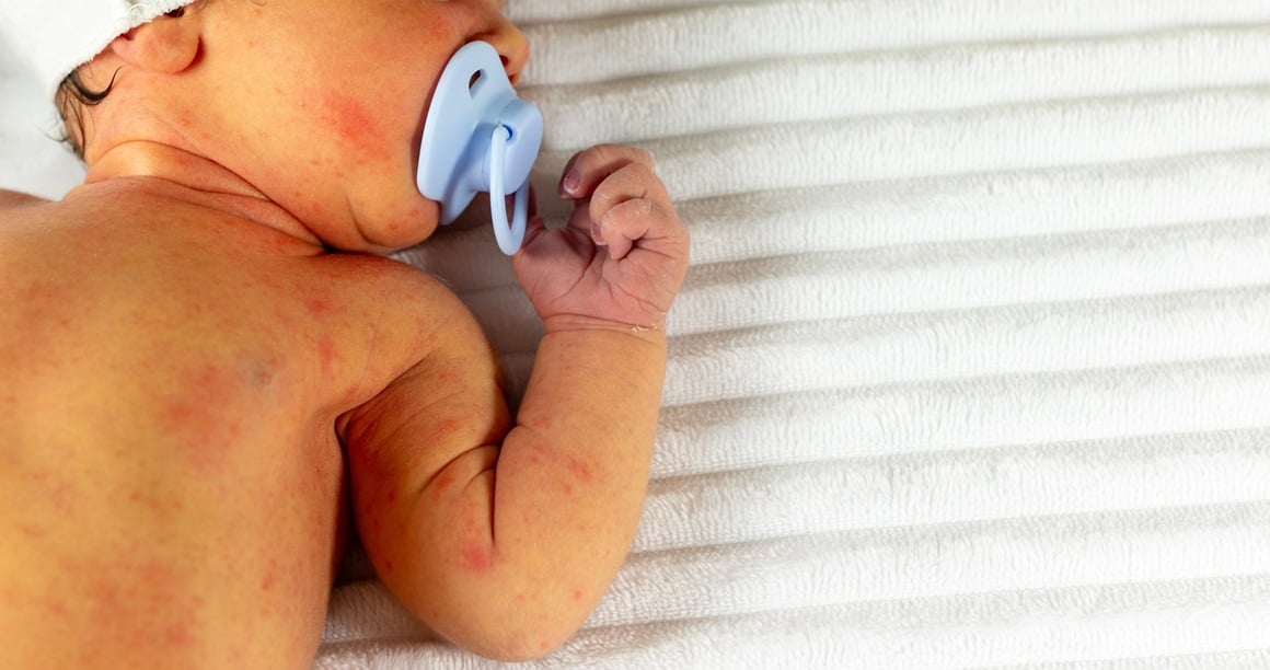 Hipotireoza kod beba - simptomi