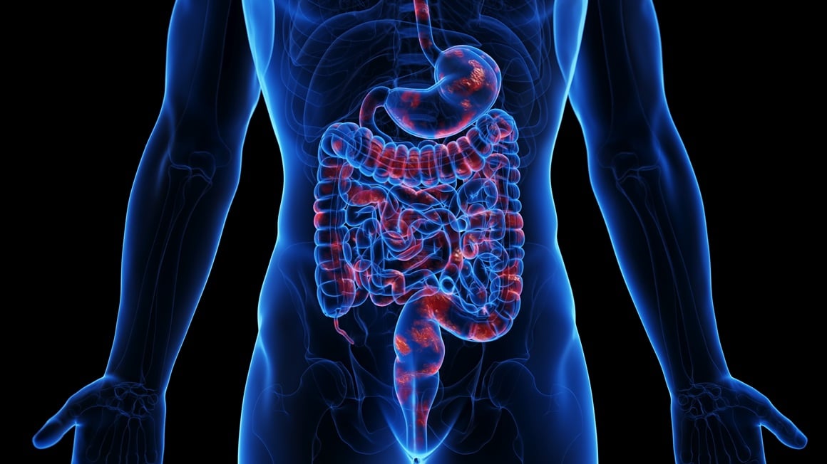 Kod Crohnove bolesti nekontrolirana upala u bilo kojoj fazi bolesti može izazvati opasne posljedice