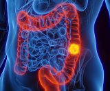 Lijekovi iz skupine GLP-1 agonista, koji se sve češće koriste u liječenju dijabetesa tipa 2 i pretilosti, mogli bi smanjiti rizik od raka debelog crijeva