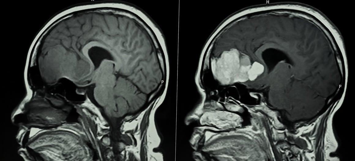 Magnetska rezonancija s kontrastom može uzrokovati migrene