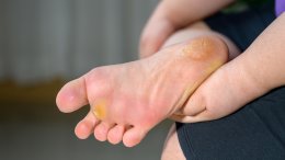 Najčešći i ujedno bezopasan uzrok žutih tabana su žuljevi i zadebljana koža