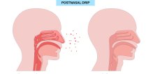 Postnazalni drip označava pojačano slijevanje sluzi iz nosa i sinusa prema stražnjem dijelu ždrijela