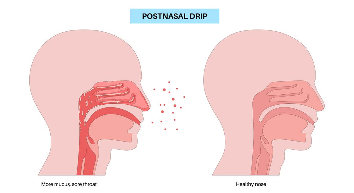 Postnazalni drip označava pojačano slijevanje sluzi iz nosa i sinusa prema stražnjem dijelu ždrijela