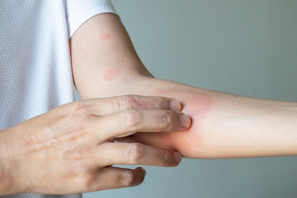 Svrbež je jedan od najneugodnijih simptoma psorijaze