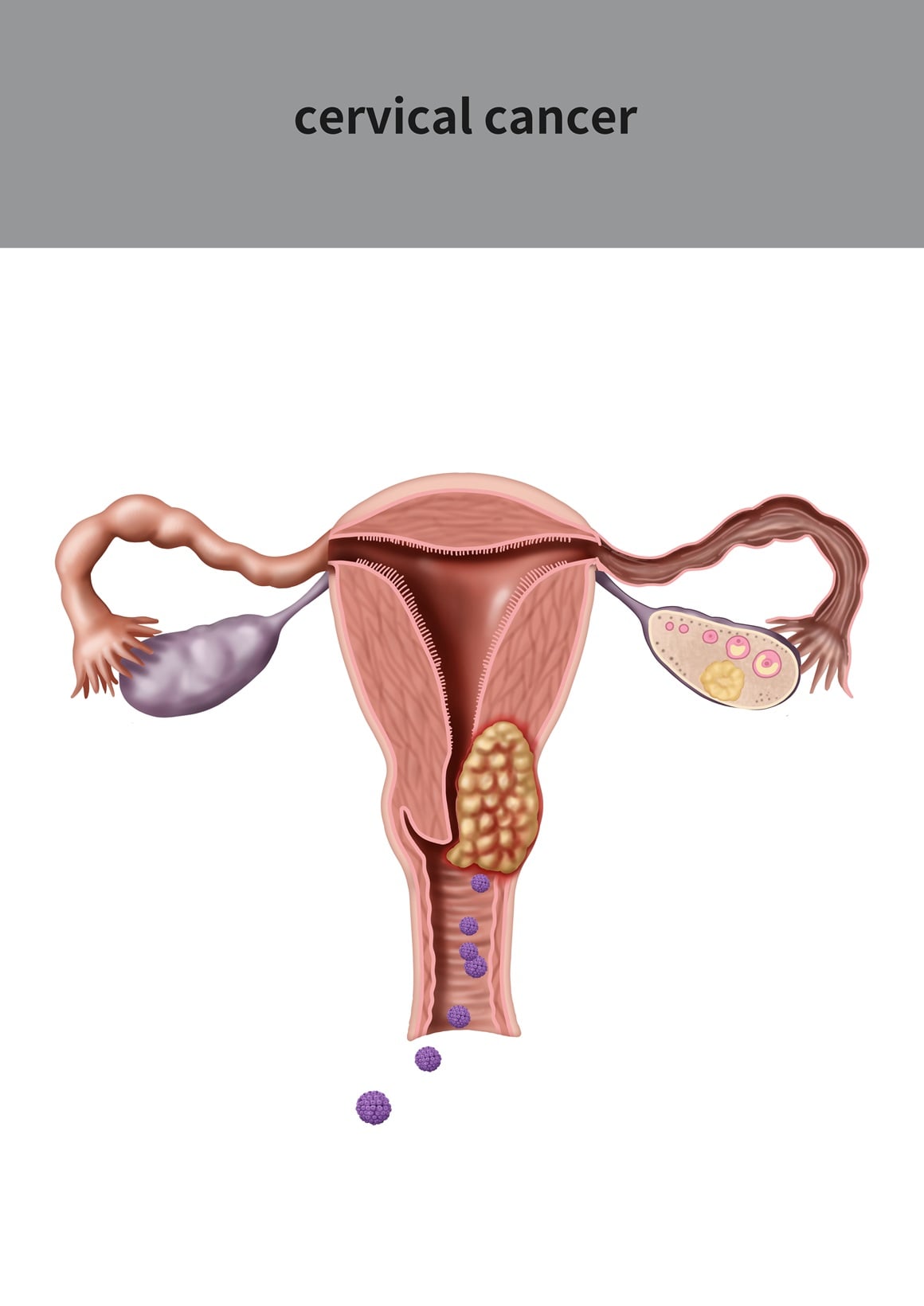 U Hrvatskoj posljednjih 10-ak godina od raka vrata maternice oboli oko 300 žena godišnje, dok ih između 120 i 130 umre