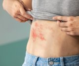 Većina ljudi ne zna ovo o herpes zosteru, a posljedice mogu trajati godinama