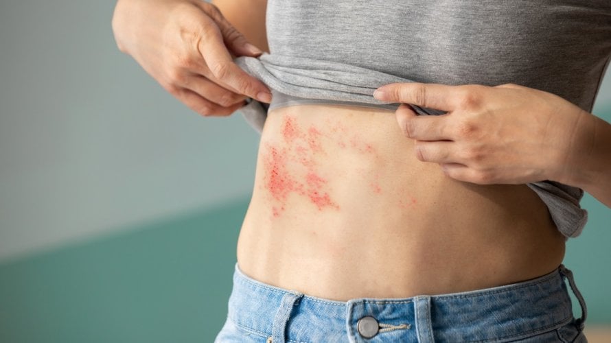 Većina ljudi ne zna ovo o herpes zosteru, a posljedice mogu trajati godinama