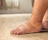 Više od 14 posto odraslih osoba ima neki oblik kronične bolesti bubrega