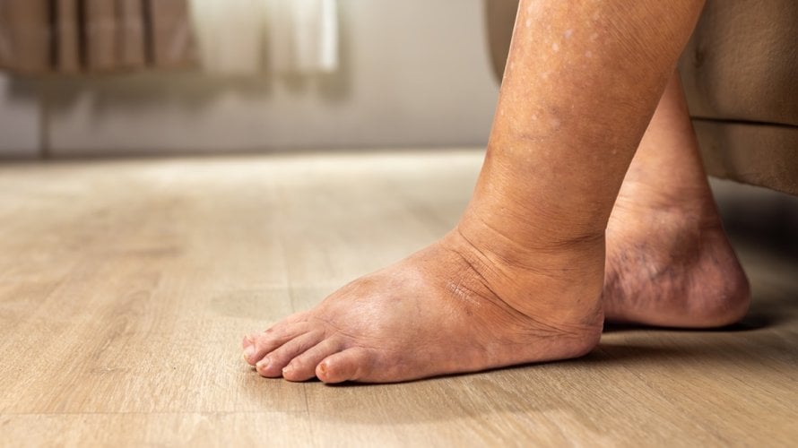 Više od 14 posto odraslih osoba ima neki oblik kronične bolesti bubrega