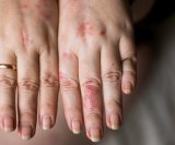 Zima je zapravo najbolje vrijeme za rješavanje akni, rozaceje i suhe kože