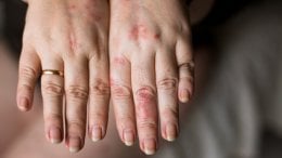 Zima je zapravo najbolje vrijeme za rješavanje akni, rozaceje i suhe kože