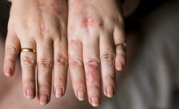 Zima je zapravo najbolje vrijeme za rješavanje akni, rozaceje i suhe kože