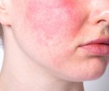 Zimski mjeseci mogu biti posebno izazovni ako imate rozaceju