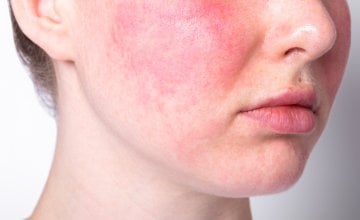 Zimski mjeseci mogu biti posebno izazovni ako imate rozaceju