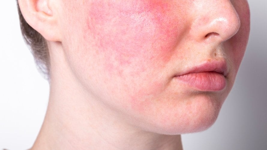 Zimski mjeseci mogu biti posebno izazovni ako imate rozaceju