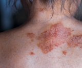 Život sa psorijazom često je izazovan